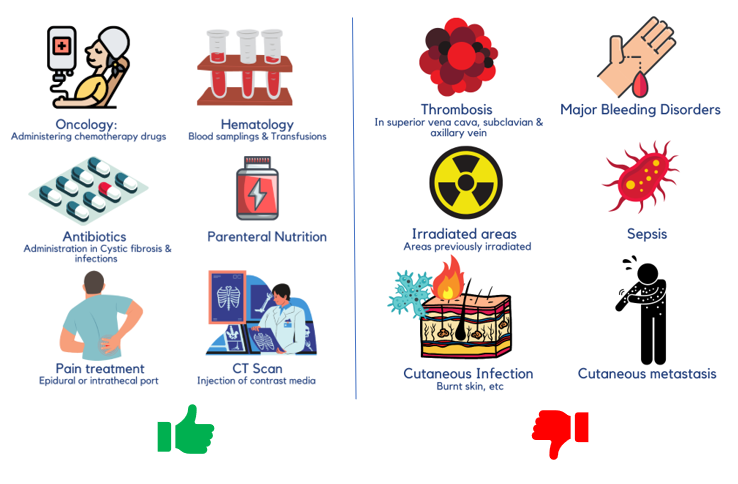 Catheters and Ports in Cancer Treatment