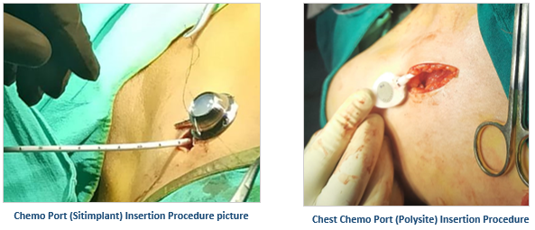 What is Chemo Port  Chemoport Surgery in Gurgaon, Gurugram, UP