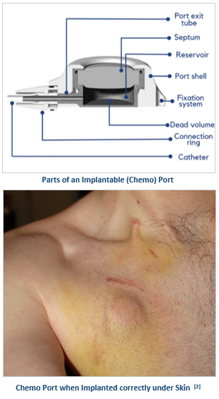 Things To Consider Regarding Chemo Port Insertion