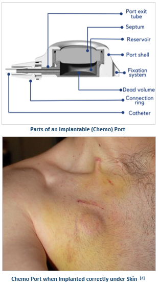 Tube For Intravenous Fluids Injections To Implantable Port For